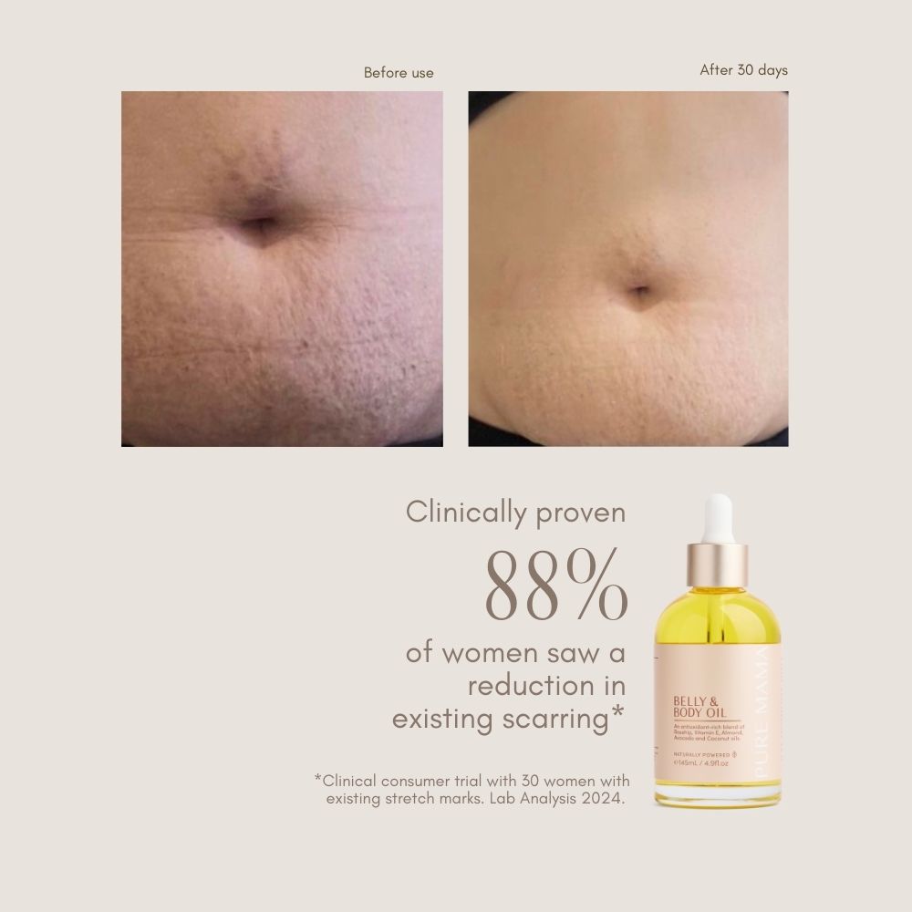 Stretch Mark Savior Set