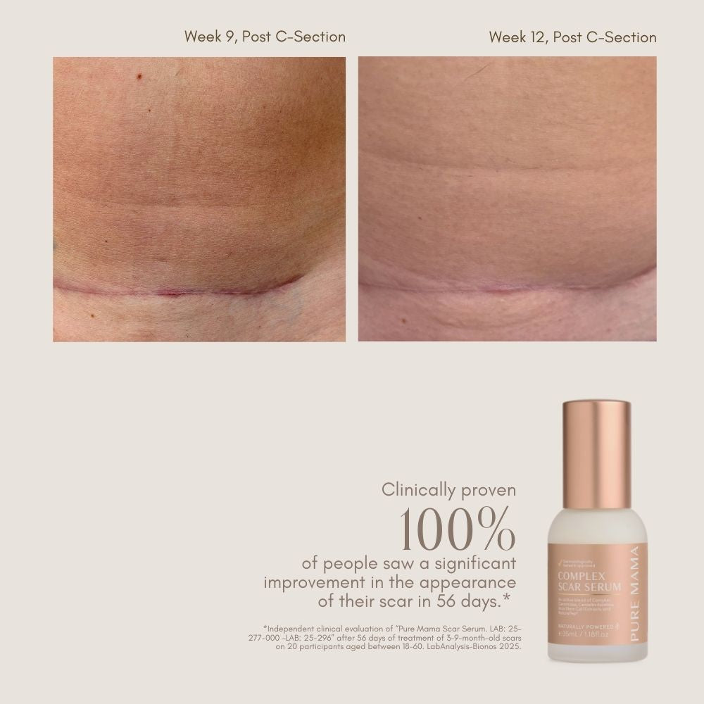 C-Section Scar Recovery BUNDLE