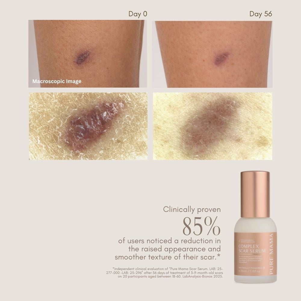 C-Section Scar Recovery BUNDLE