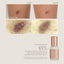 C-Section Scar Recovery BUNDLE