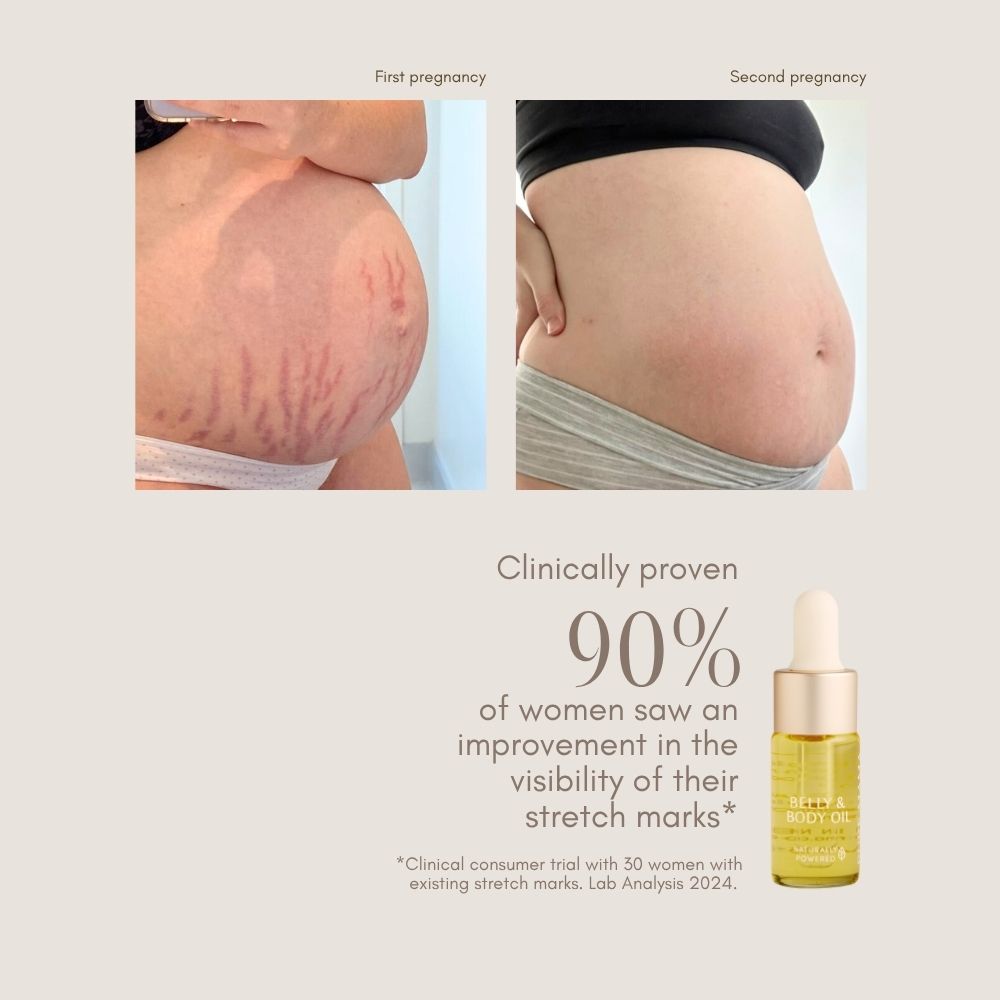 Side-by-side of a pregnant belly with stretch marks (first pregnancy) and fewer marks (second pregnancy), featuring Pure Mama NZ Belly Oil Mini and highlighting its clinical improvement for pregnancy skincare.