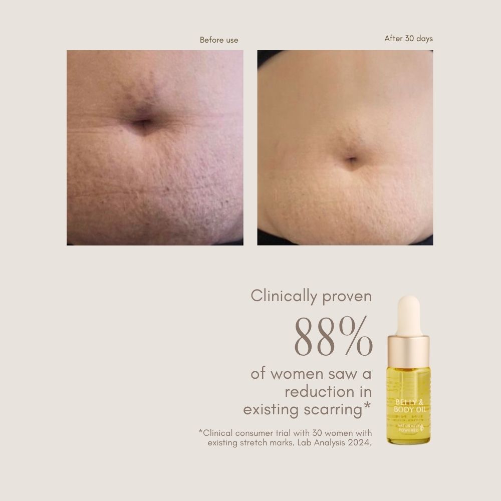 Two close-up images show skin with stretch marks before and after 30 days using Pure Mama NZ Belly Oil Mini. Text notes 88% of women saw reduced scarring; a dropper bottle image highlights its pregnancy skincare benefits.